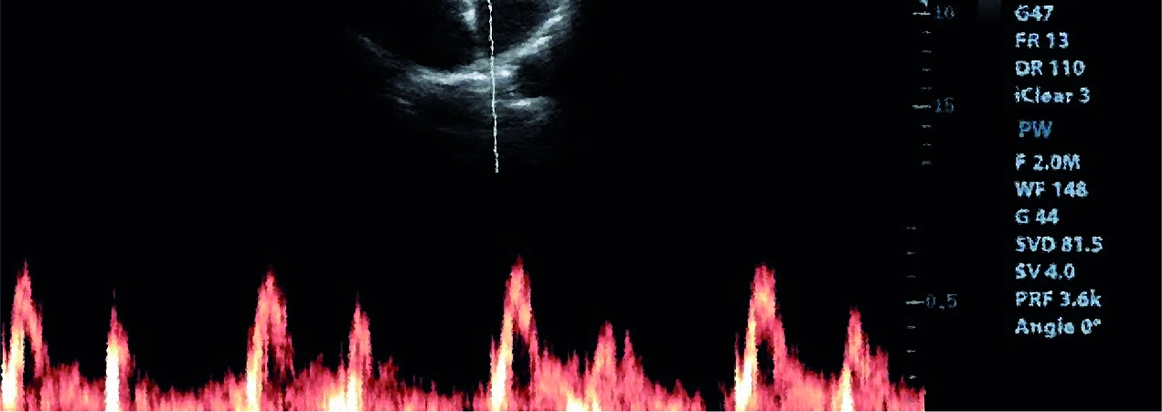Curso Universitario de Estudios Avanzados en Ultrasonografía de Tórax (Tercera versión)